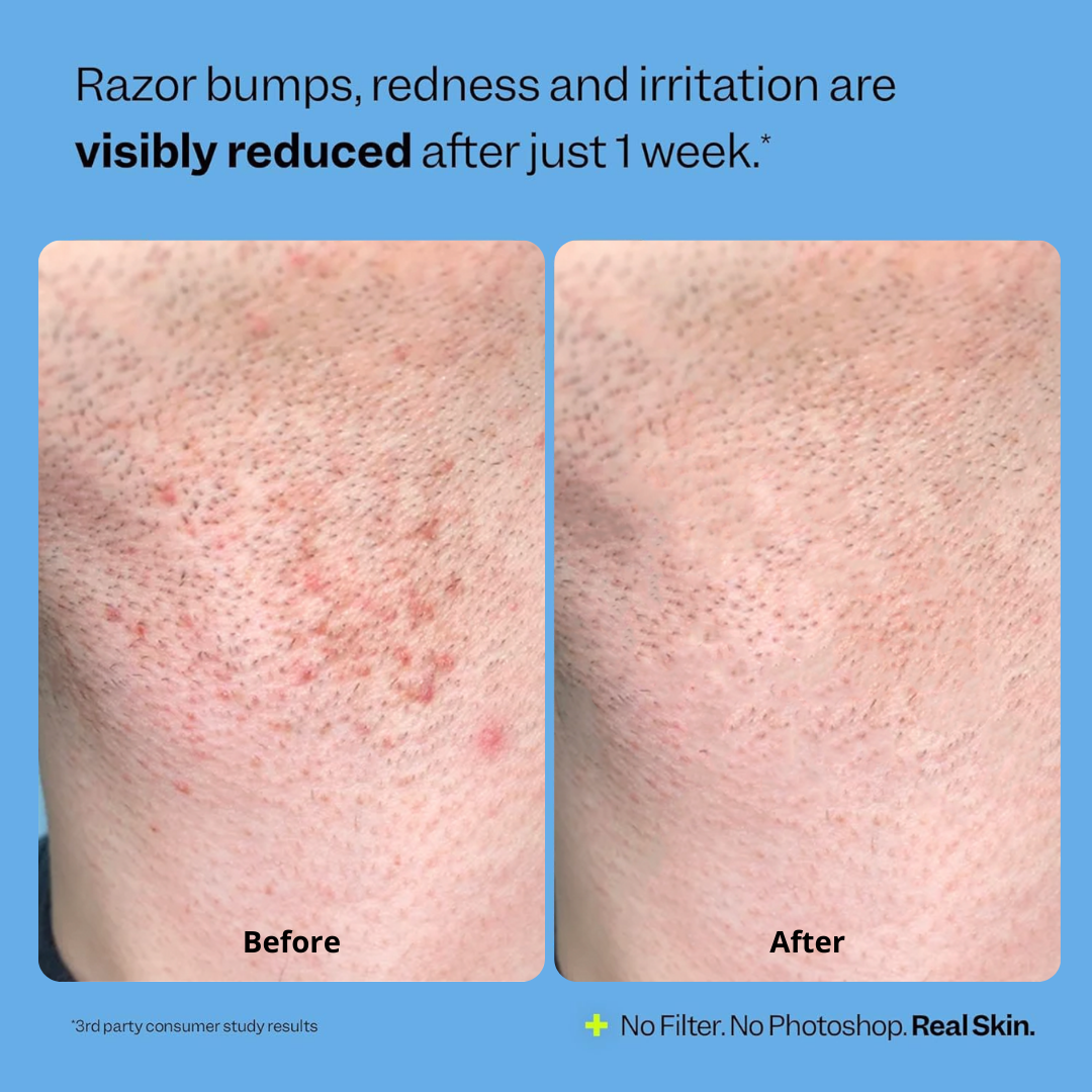 Ingrown Hair Smoothing Solution