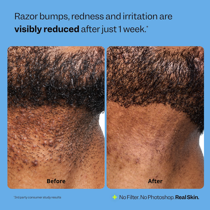 Ingrown Hair Smoothing Solution