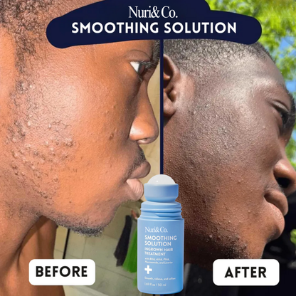 Ingrown Hair Smoothing Solution